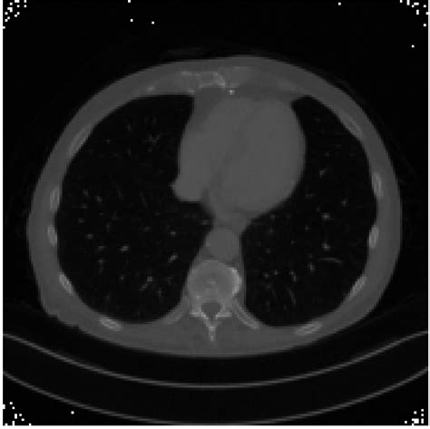 Poisson Noise To The Ct Image Using Pytorch Tensor Pytorch Forums