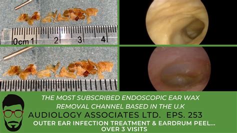 Outer Ear Infection Treatment And Eardrum Peel Over 3 Visits Ep 253