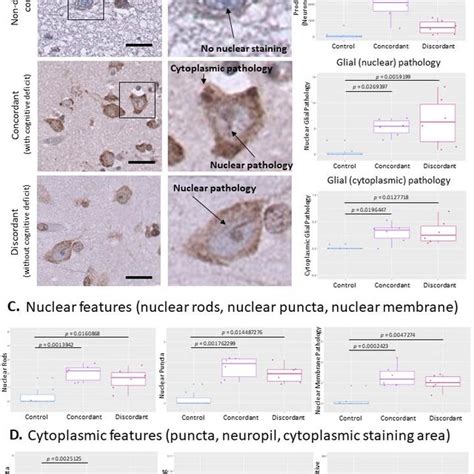 Tdp Pathology Detected By Rna Aptamer Correlates With Molecular