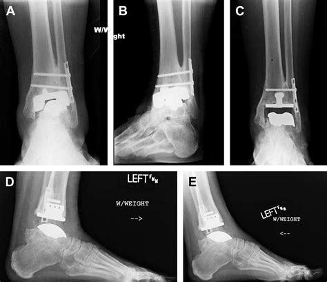 Revision Total Ankle Replacement Foot And Ankle Clinics