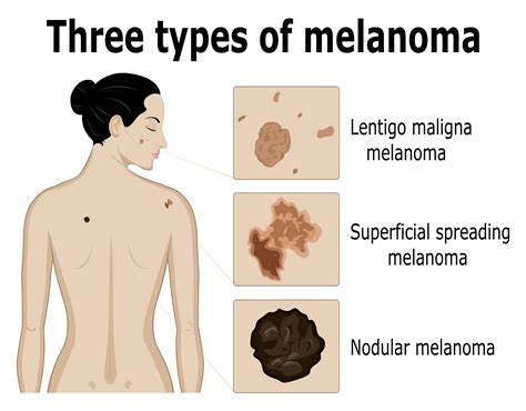 Skin Cancer Stage One - CancerWalls