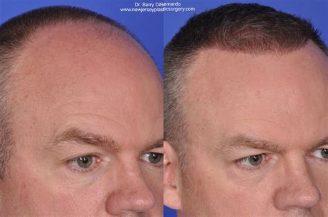 Smartgraft Hair Transplant Before And After Photos Patient 36 Houston