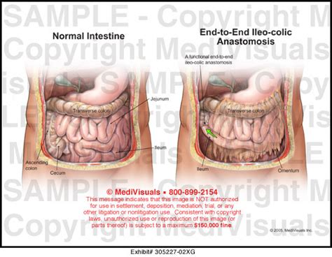 End To End Ileo Colic Anastomosis Medical Illustration Medivisuals