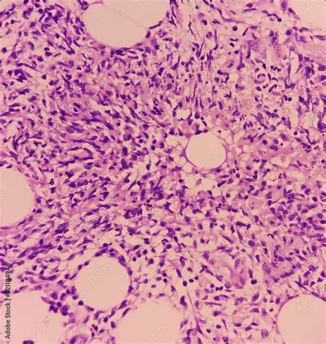 Foto De Granulomatous Inflammation With Tuberculosis Microscopic Show