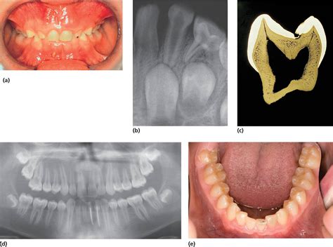 Developmental Defects Of The Dental Hard Tissues And Their Treatment