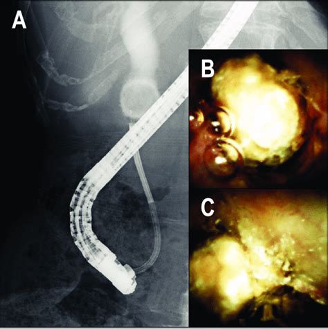 Per Oral Cholangioscopy Assisted Electrohydraulic Lithotripsy Ehl