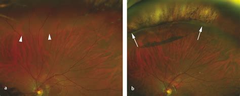 Retinal Dialysis | Ento Key