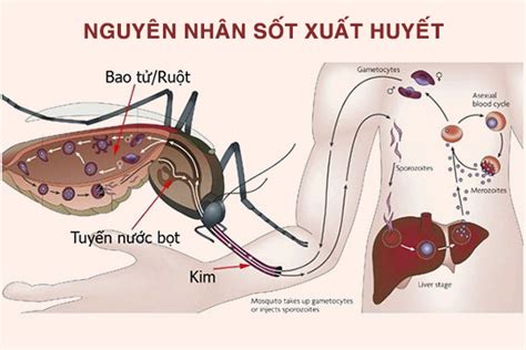 Sốt Xuất Huyết Nguyên Nhân Chẩn đoán And Phương Pháp điều Trị Trạm Y