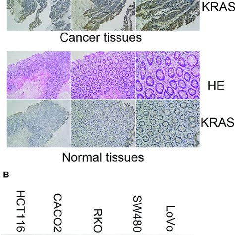 The Expression Of KRAS In CRC Tissues And Cells A Representative