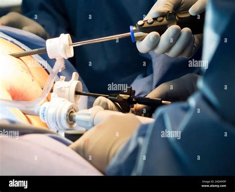 Appendix Removal Surgery Surgeons Performing A Laparoscopic Keyhole