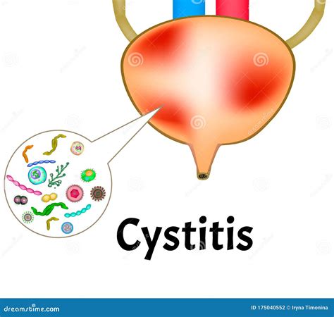 Cystitis Inflammation Of The Bladder The Structure Of The Kidneys And