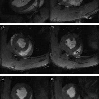 Cardiac MRI Short Axis Image Taken From A Long Axis A And A Short