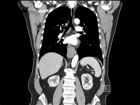 Esophagus Leiomyoma Distal Esophagus Coronal Ct Youtube