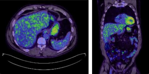 Figure From Multifocal Nodular Hepatic Steatosis A Rare Benign