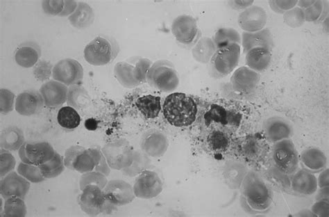 Bone Marrow Smear On Day 26 Post TX Showing A Histiocyte Containing