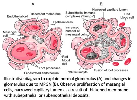 Membranoproliferative Glomerulonephritis Type 1