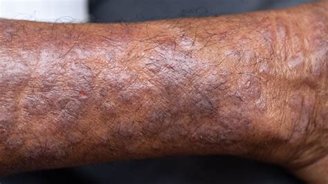 Atopic Eczema On Black Skin