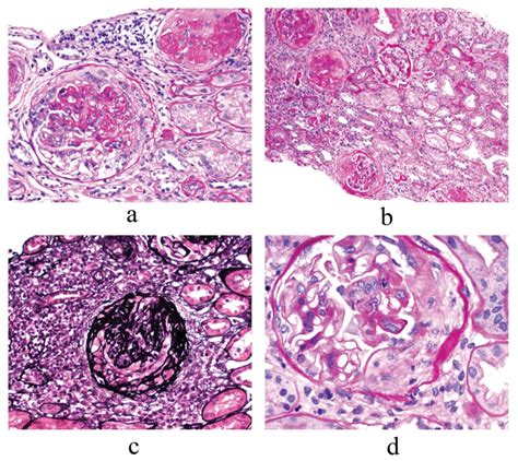 Renal Biopsy Findings Light Microscopy Lm Focal Proliferative And