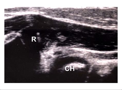 Ultrasound image of dislocation in the humeroradial joint-head of the ...