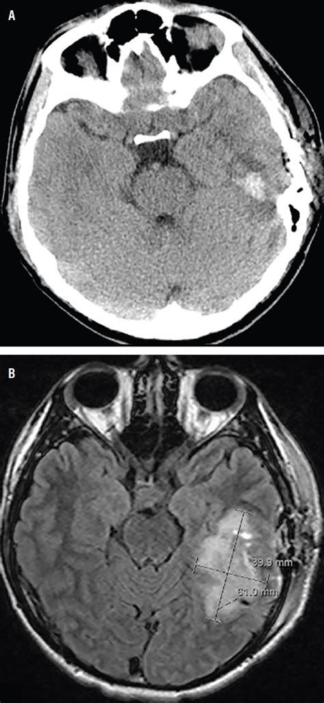 Challenge Case Report Postcovid 19 Encephalitis Practical Neurology