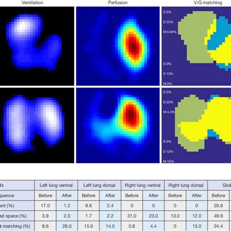 Ventilation Perfusion And V Q Matching Images Before And After Download Scientific Diagram