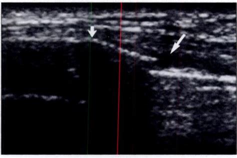 Year Old Man With Fractured Left Sixth Rib Transverse Sonogram Shows Download Scientific Diagram