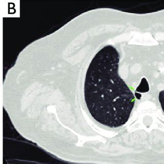 Contrast Enhanced Mdct Mm Thickness The Axial Images Of The Chest