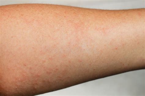 Human Skin Presenting An Allergic Reaction Stock Photo Image Of