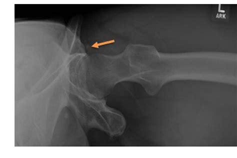 Pdf Rare Case Of Symptomatic Calcific Tendinopathy Of The Origin Of