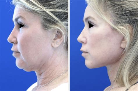 Facelifts Orange CT Mao Facial Plastic Surgery