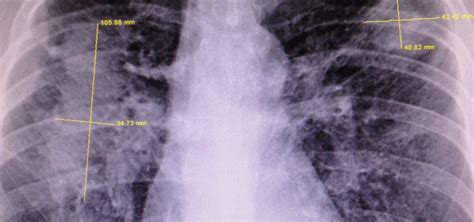 Black Lung Benefits Drop for Kentucky Coal Miners after Controversial Law Change - WOUB Public Media