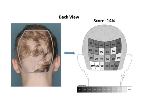 Standardizing Outcome Measures In Alopecia Areata