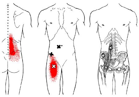 Erector Spinae Trigger Points