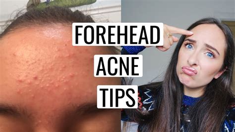 How To Get Rid Of FOREHEAD ACNE YouTube