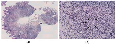 Histopathological Features Of Gastric Malt Lymphoma A Large