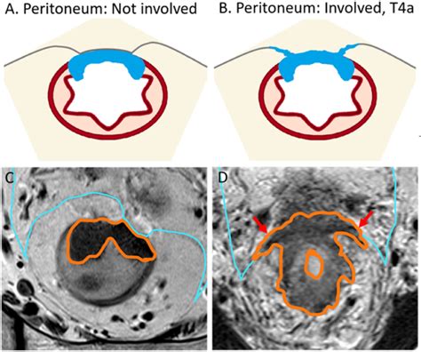 Rectal Cancer Without And With Peritoneal Involvement At The Anterior