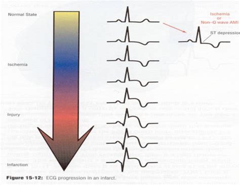 Ekg Ischemia And Infarct Diagnostics Exam Flashcards Quizlet