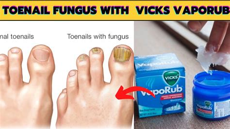 How To Get Rid Of Toenail Fungus Fast And Naturally With Bleach And