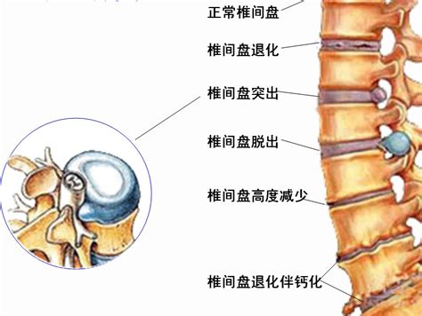 教你在家里牵引治疗你的腰椎间盘突出