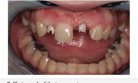 Figure From Implant Rehabilitation Of Internal Root Resorption After