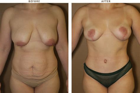 Mommy Makeover Before And After Pictures Dr Turowski Plastic