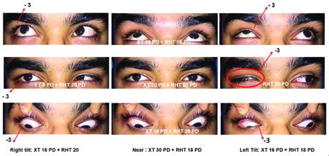 Nine Gaze Clinical Photographs Showing Abduction And Adduction Download Scientific Diagram