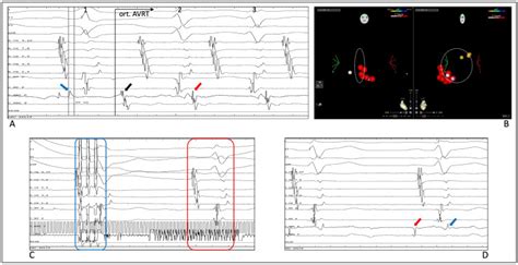 Ablation Of Accessory Pathways In Different Anatomical Locations Using