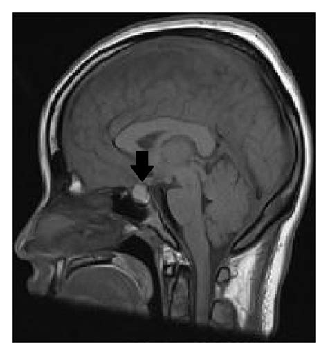 A Axial T2 Weighted Sequence Demonstrates Bilateral Csf Intensity