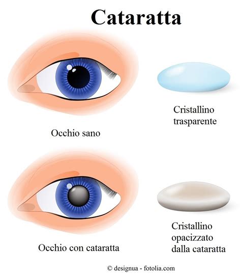 Cataratta All Occhio Congenita O Secondaria Sintomi Intervento