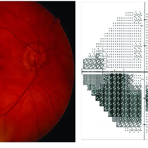 Right eye, fundoscopy and perimetry (Zeiss, HFA 24-2 SITA standard):... | Download Scientific ...