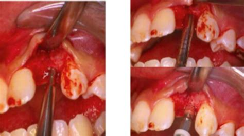 Exam 1 3 Bone Grafting Undetailed Done Flashcards Quizlet