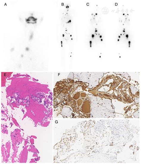 Hyperthyroidism Secondary To Disseminated Differentiated Thyroid Cancer