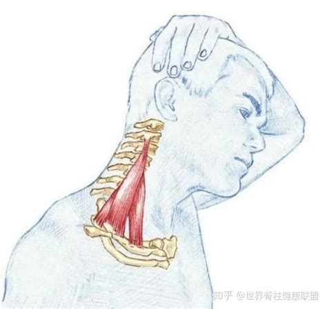 和上半身疼痛关系很大的一条肌肉，斜角肌 知乎