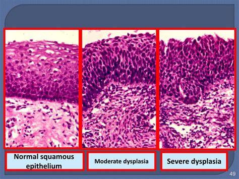 Ppt Neoplasia Powerpoint Presentation Free Download Id 6161338